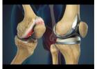 Top Knee Replacement Surgeon in Vaishali Nagar – Dr. Arvind Asopa